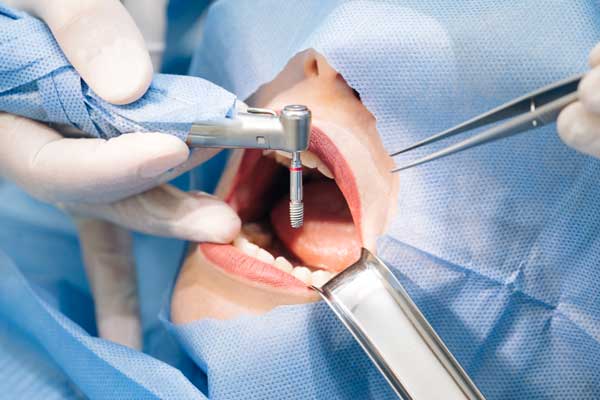 dental Implant patient