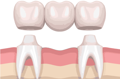 Dental Bridge stafford