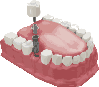 dental-implants-treatment-procedure-medically-accurate-3d-illustration-dentures-concept