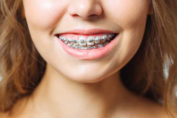 Woman smiling with fixed braces