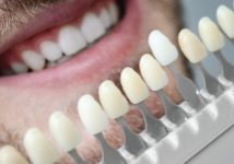 Dental-Veneer-St-Marys-Dental-Practice-Stafford