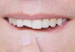 Man-cracked-tooth-dental-emergency-stafford